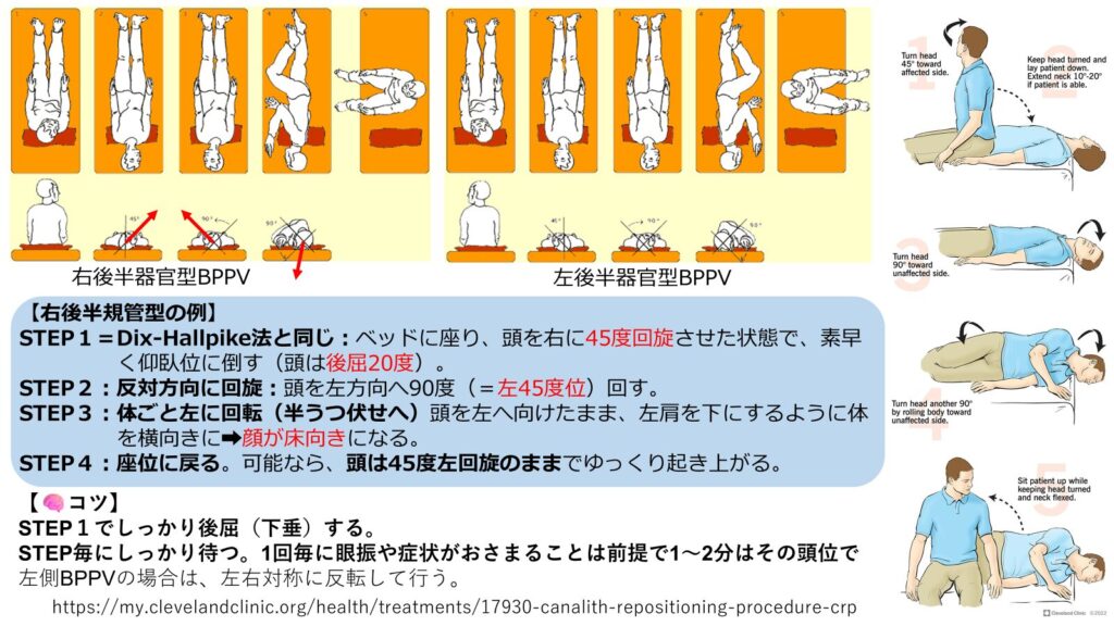 Epley法